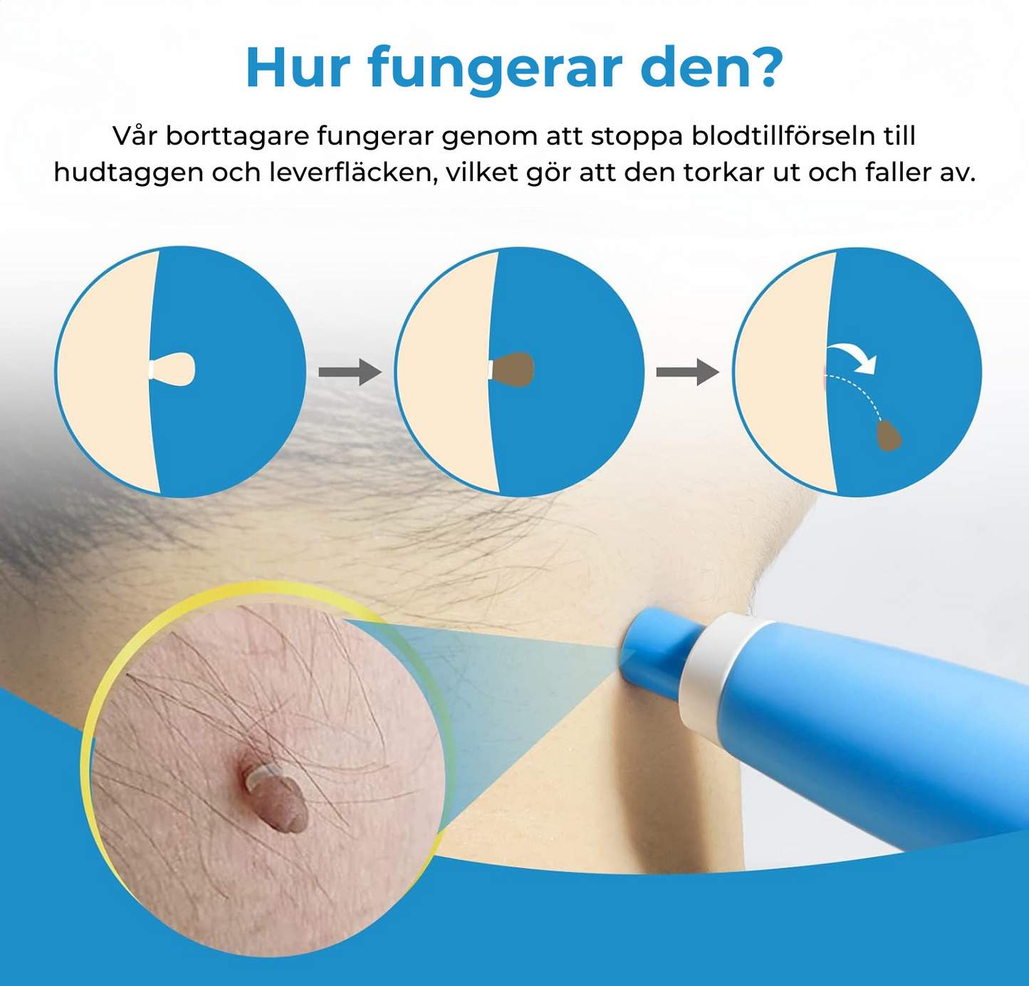 Liver Spot Removal - Removal of Birthmarks