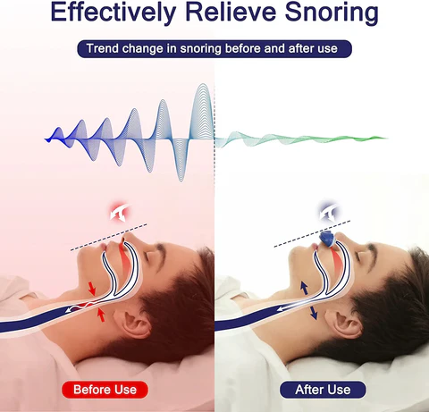 Charly | Micro CPAP Anti-Snoring Device | Maskless Sleep Apnea Treatment