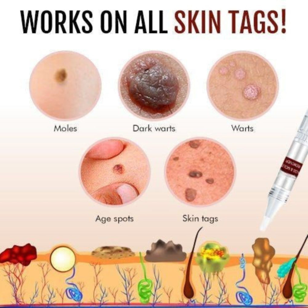 Charly | Natural Skin Tag & Mole Remover Pen