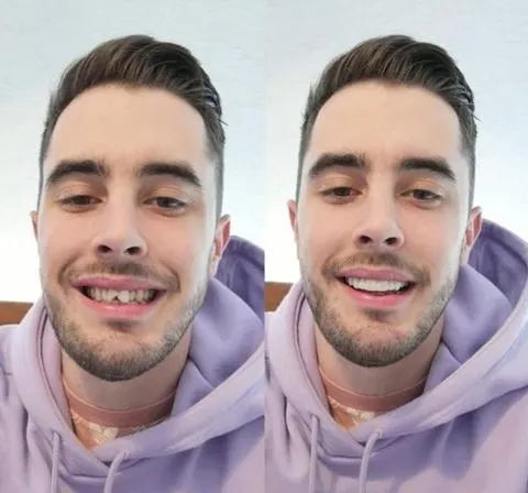 Charly | On Smile Veneers (Upper and Lower Jaw included)
